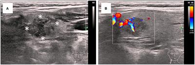 Minimal change disease associated with thyroid cancer: a case report